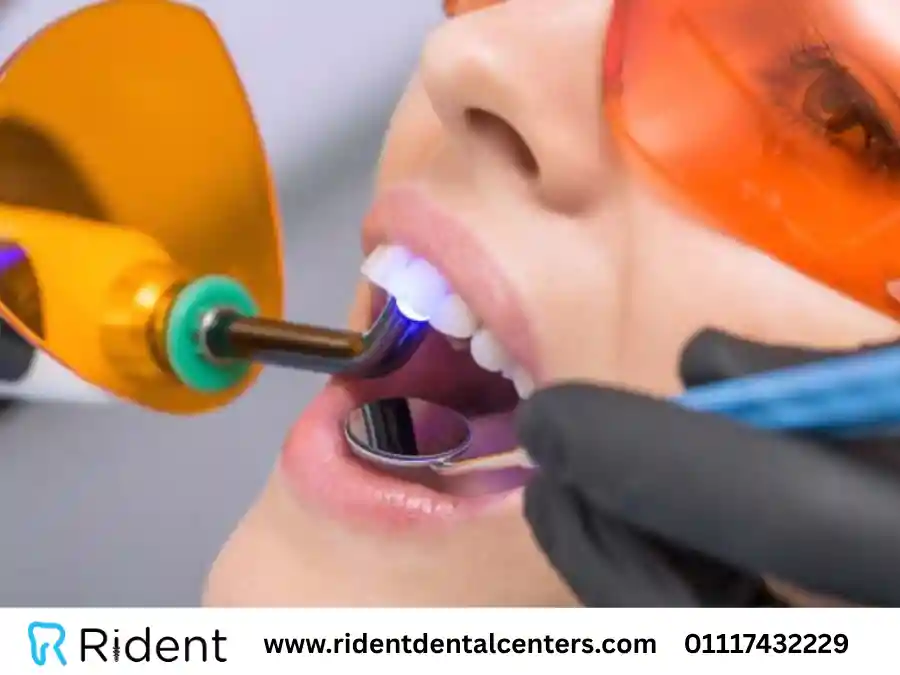 حشو الاسنان بالليزر